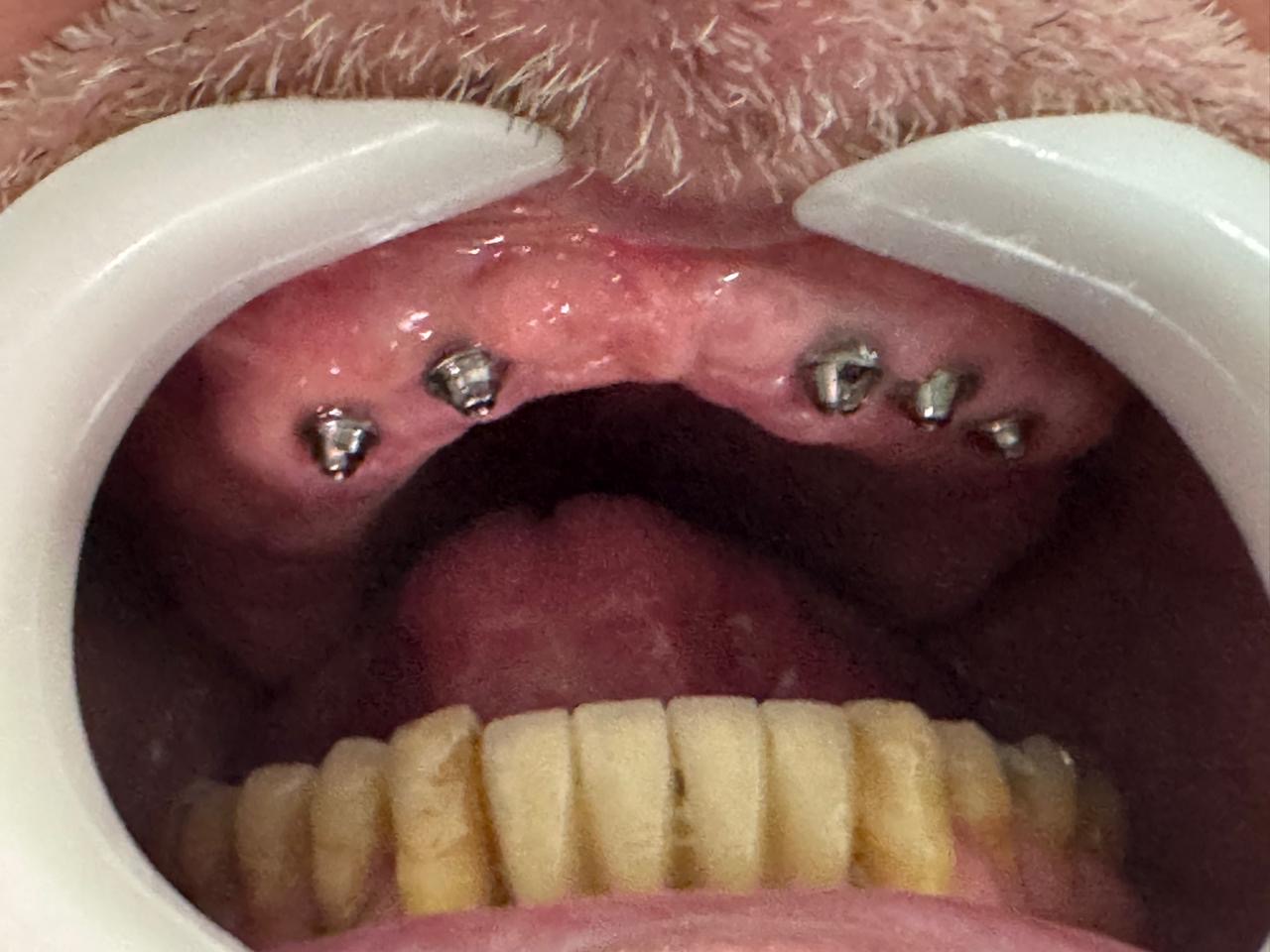 Antes — Instalação dos implantes para confecção de uma Prótese Protocolo superior (dentadura fixa)